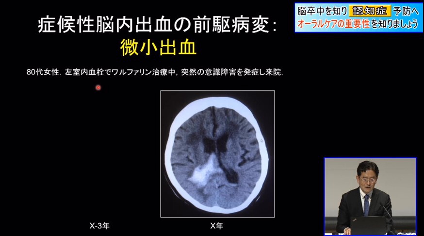 オーラル ケア 認知 症 クリアランス